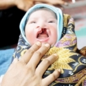 Banyak Penderita Bibir Sumbing Belum Dijamin BPJS
