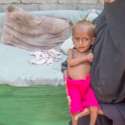 85 Ribu Anak Meninggal Karena Malnutrisi Akut Di Yaman