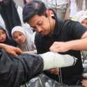 Bukan Sekadar Kaki Palsu, Teknologi Direct Socket Kembalikan Langkah Pasien