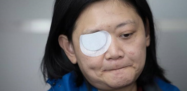 Buta Akibat Ditembak Peluru Karet, Jurnalis Indonesia Terus Desak Kepolisian Hong Kong