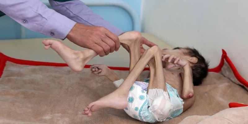 Kelaparan Dan Kekurangan Gizi Parah, Bocah Tujuh Tahun Asal Yaman Hanya Memiliki Bobot 7 Kilogram
