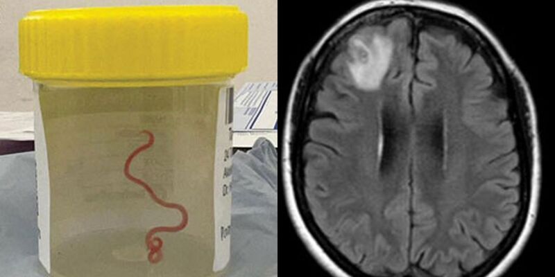 Pertama di Dunia, Cacing Parasit Hidup di Otak Manusia