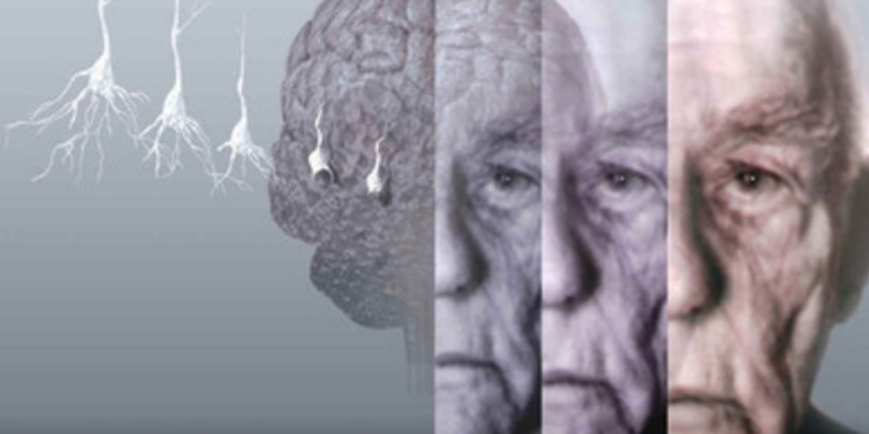 Gunakan AI, Ilmuwan Temukan Cara Prediksi Alzheimer Tujuh Tahun Sebelum Gejala Muncul