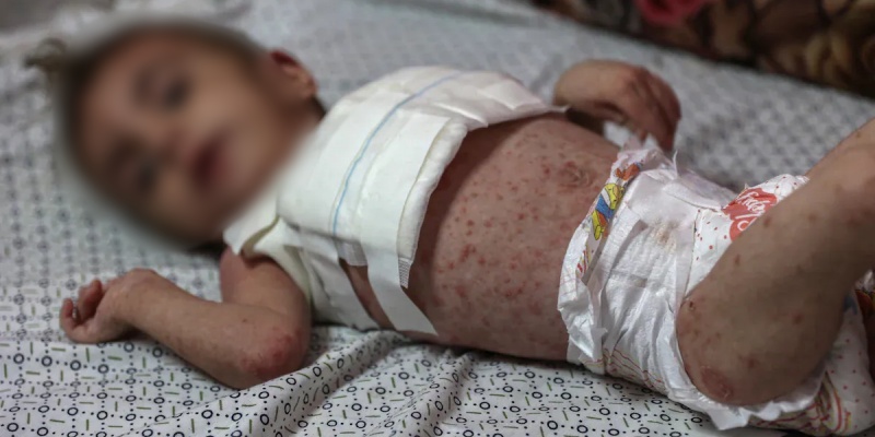 Penyakit Kulit Berbahaya Serang Anak-anak Gaza