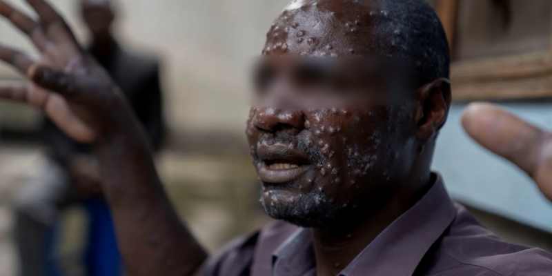 Afrika Butuh Rp9,2 Triliun untuk Tangani Wabah Mpox