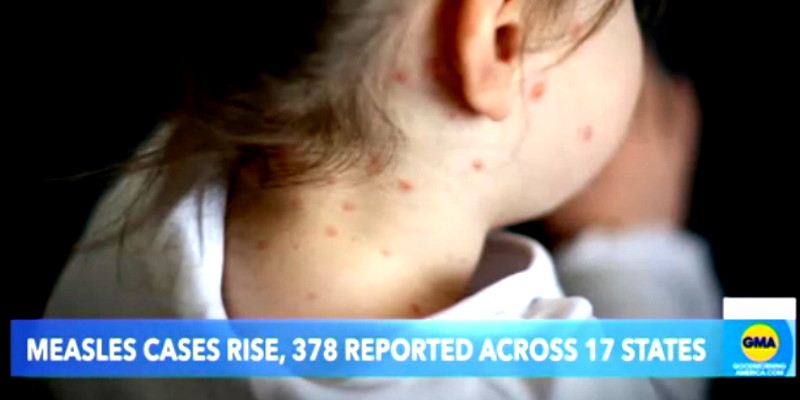 Wabah Campak Mengerikan, Kasus Meledak 20 Persen di Texas dan New Mexico