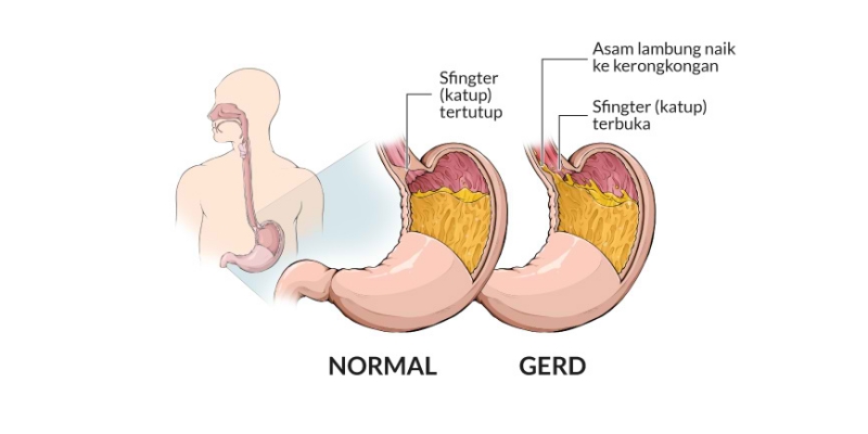 Jangan Asal Minum Obat Herbal Saat “Masuk Angin” Tak Kunjung Sembuh