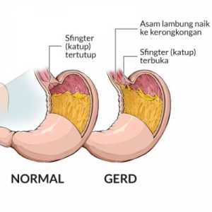 Jangan Asal Minum Obat Herbal Saat “Masuk Angin” Tak Kunjung Sembuh