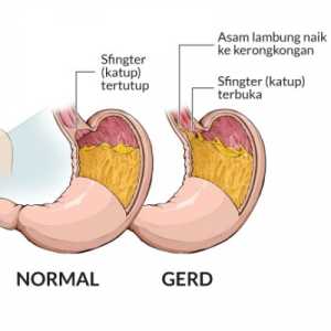Punya Riwayat GERD? Perhatikan Hal Ini Sebelum Minum dan Makan