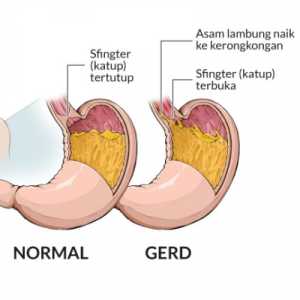 Masuk Angin Vs GERD, Obat Herbal Tak Selalu Aman