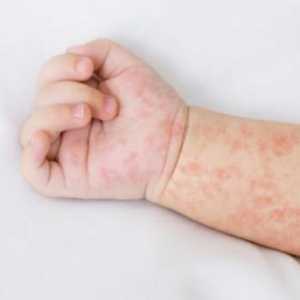 Waspada Kasus Campak Meningkat