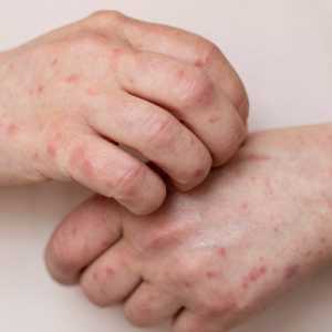 3 Gejala Campak yang Perlu Diwaspadai, Jangan Sampai Salah